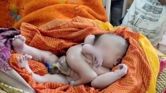 Bebê nasce com quatro braços e quatro pernas na Índia e é tratado como um deus