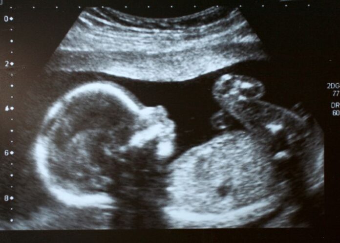 Ultrassom de feto (Foto: Canva Pro)